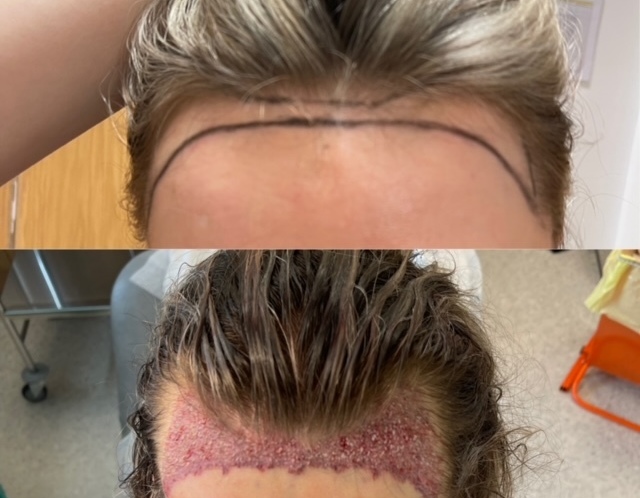 Elite Hair Restoration FUT Female Hair Line Reshaping Surgery Day Photos Before & After