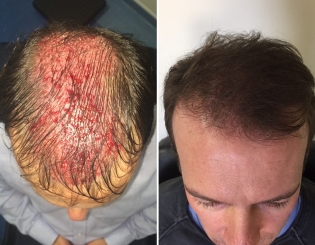 Elite Hair Restoration FUT 2,500 Grafts 12 Months Post Surgery Results