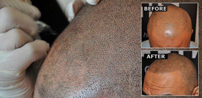 Elite Hair Restoration Scalp Micro Pigmentation Before & After Treatment Results