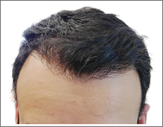 Elite Hair Restoration Post Surgery 12 Months After Operation Results Photo