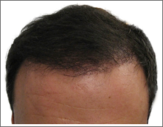 Elite Hair Restoration 12 Months Post Surgery Results Photo 2,500 Grafts FUT