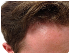 Elite Hair Restoration Post Surgery 12 Months Results 1250 FUE Grafts