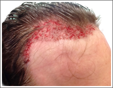 Elite Hair Restoration New Hair Line Temple Infill 1250 Grafts FUE